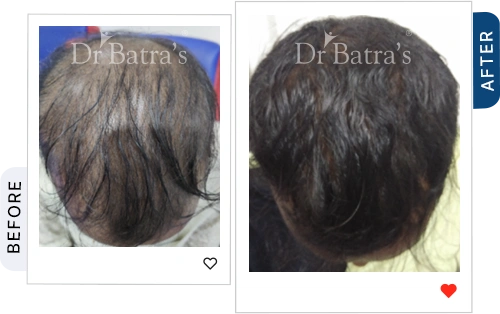 trichotillomania-and-Stress-01-before-after.webp