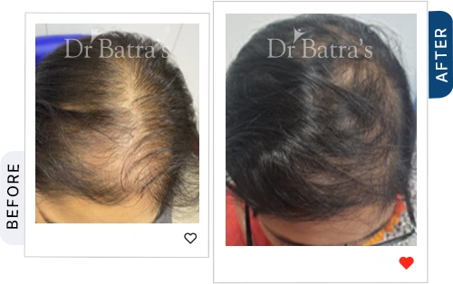 trichotillomania-and-Stress-02-before-after.webp