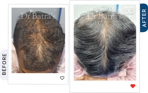 trichotillomania-and-Stress-03-before-after.webp