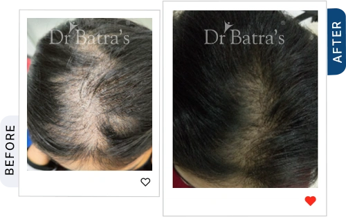 trichotillomania-and-Stress-04-before-after.webp