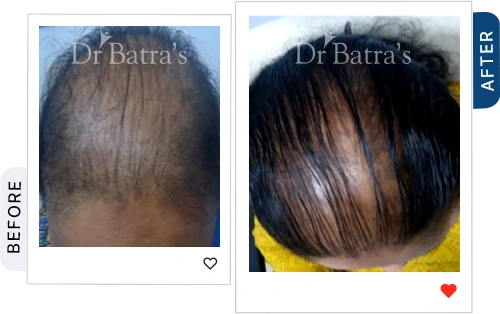 trichotillomania-and-Stress-05-before-after.webp