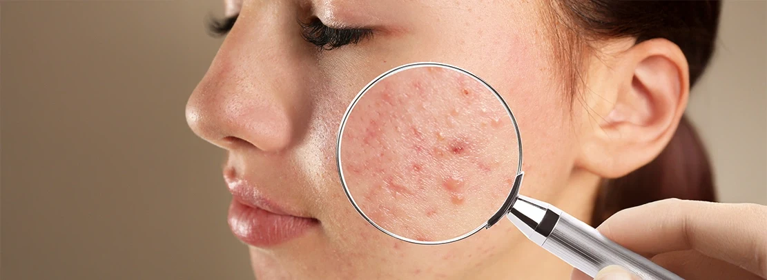 10 most common skin disorders