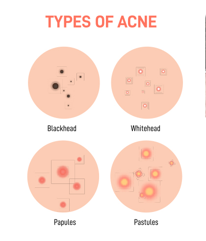 Acne: Get Rid of It Naturally with Homeopathy - Dr Batra's