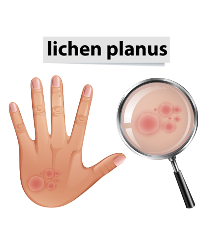 Lichen Planus & Depression — What's the Connection?