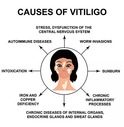 4 mistakes to avoid during vitiligo treatment