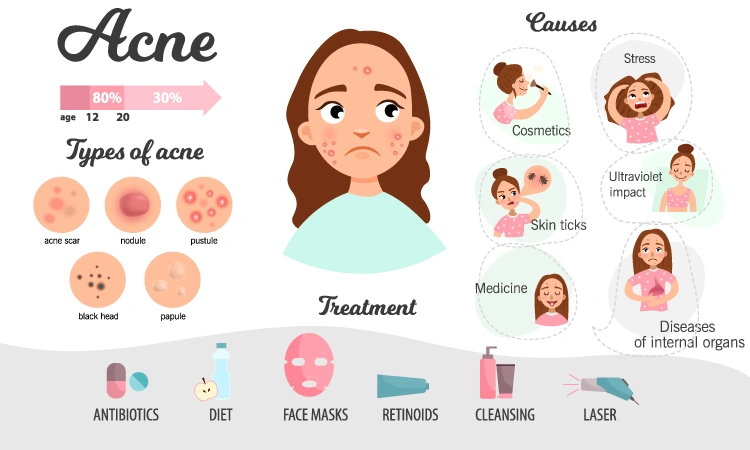 Top 13 commonly asked questions about acne - Dr Batra’s®