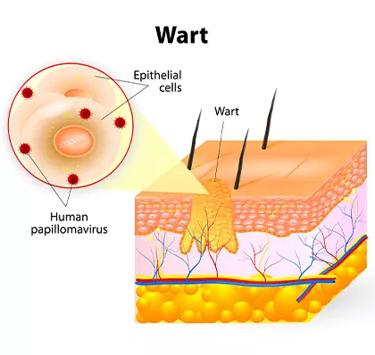 Are warts hard?