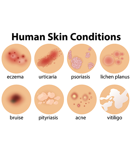 Can homeopathy help with skin diseases | Dr Batra’s™