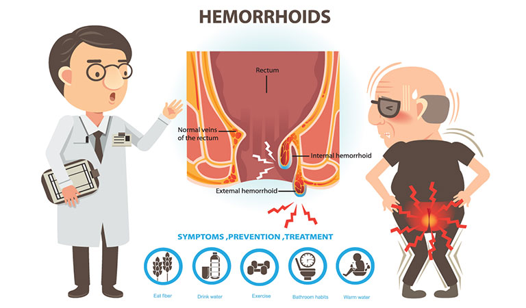 Best Homeopathic Medicine Treatment For Piles And Hemorrhoids Dr Batras