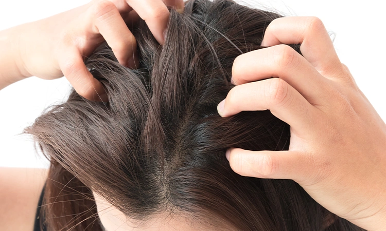 Home Remedies for Itchy Scalp