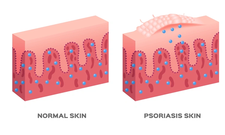 How can I stop psoriasis from spreading?