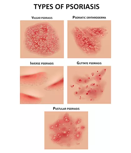 Psoriasis Gets Worse In Summer? - Dr. Batra’s®