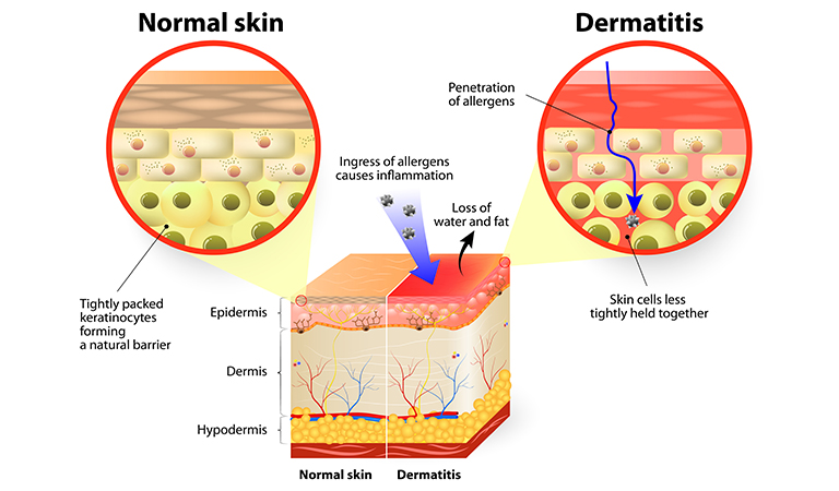 Seborrheic Dermatitis vs. Atopic Dermatitis | Dr Batra’s™