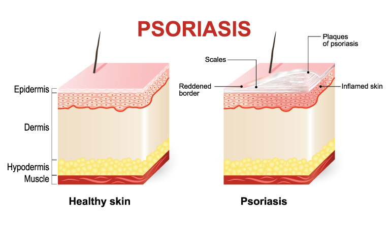 Psoriasis triggers that cause eruption