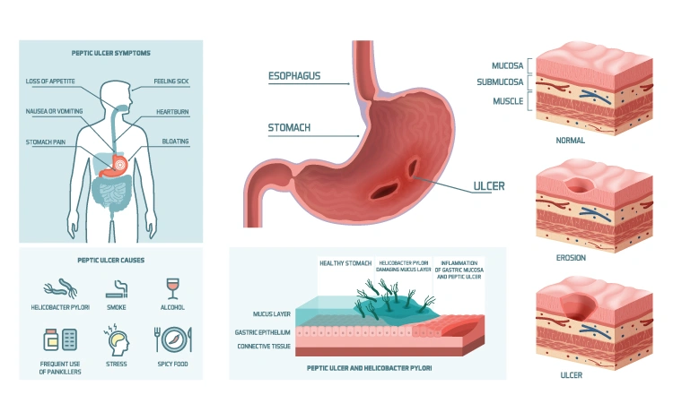 Homeopathy relives tummy ulcers gently