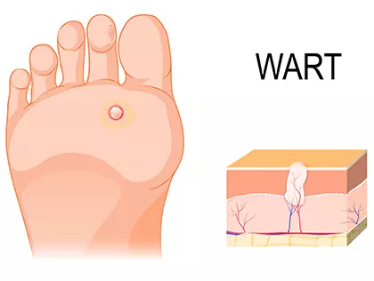 Warts: Types and treatment