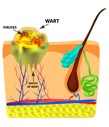 What Causes Warts On The Legs? - Dr. Batra’s®