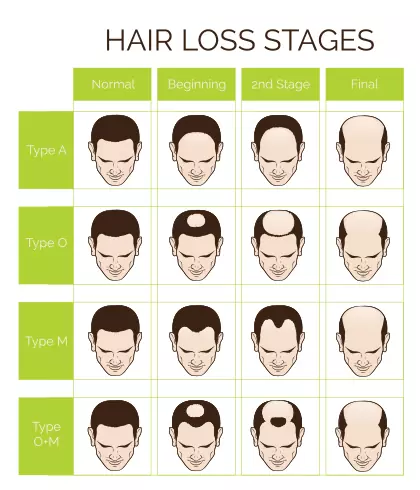 What to do about male pattern hair loss?