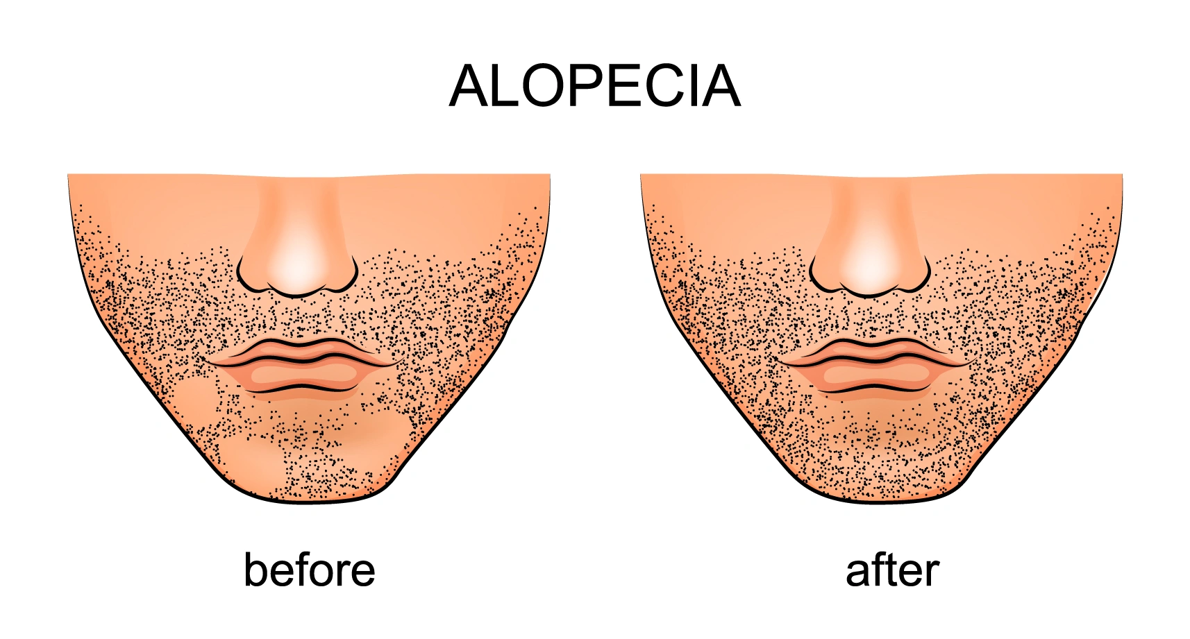 Is alopecia areata permanent?