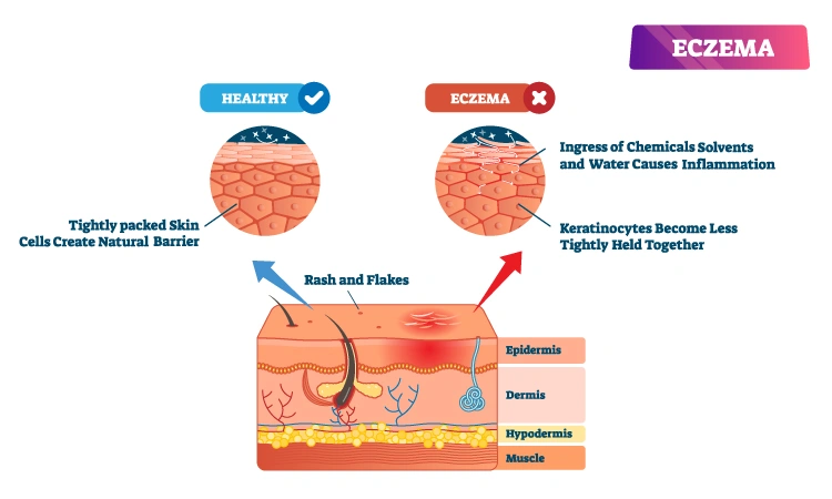 Eczema Treatment