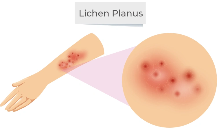 How long does lichen planus take to clear up?