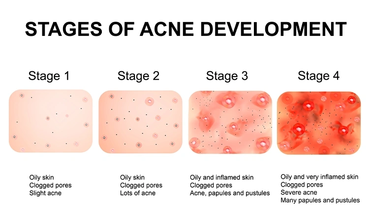 Reasons for acne on face