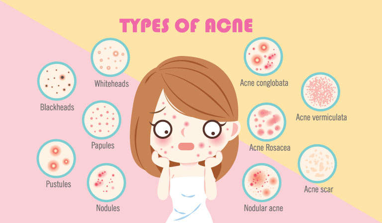 Acne myths we’ve all fallen for