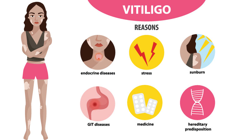 All you need to know about vitiligo | Dr Batra’s™