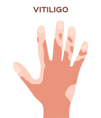 Homeopathy: Best treatment for Vitiligo