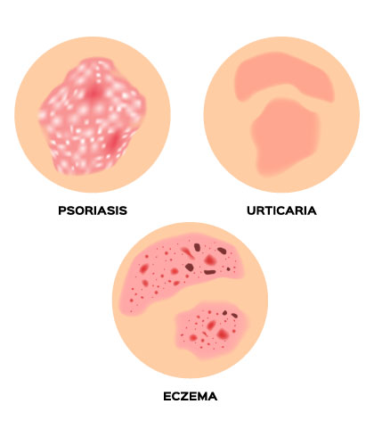 Clear eczema with homeopathy