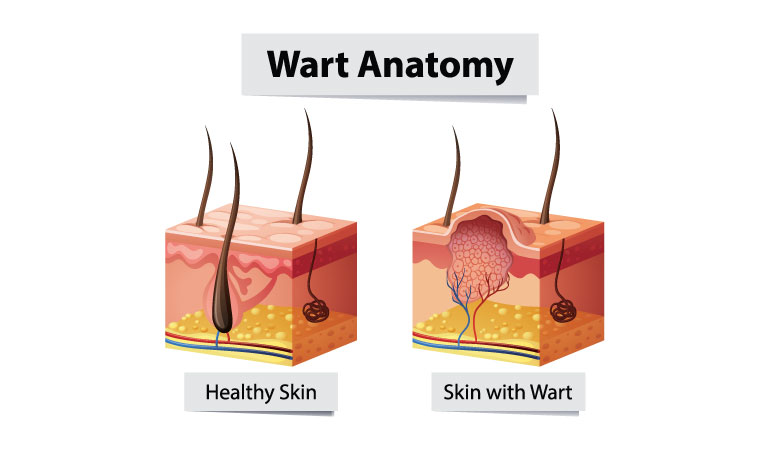 Types of warts & homeopathy treatment