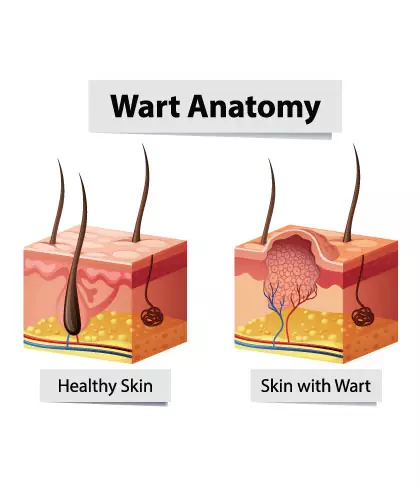 Causes of warts