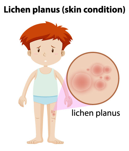 Lichen Planus – Causes and treatments