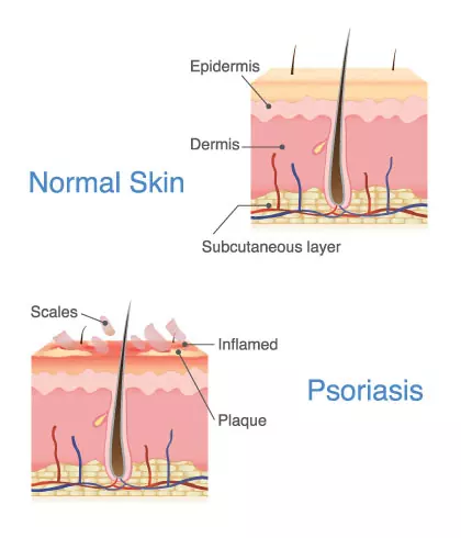 What does psoriasis look like on the scalp?