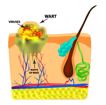 What are Genital Warts?