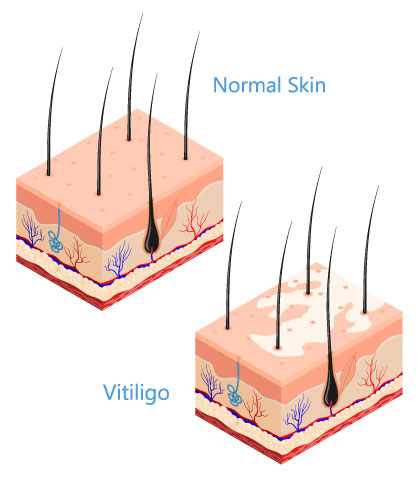 What causes vitiligo skin disease?