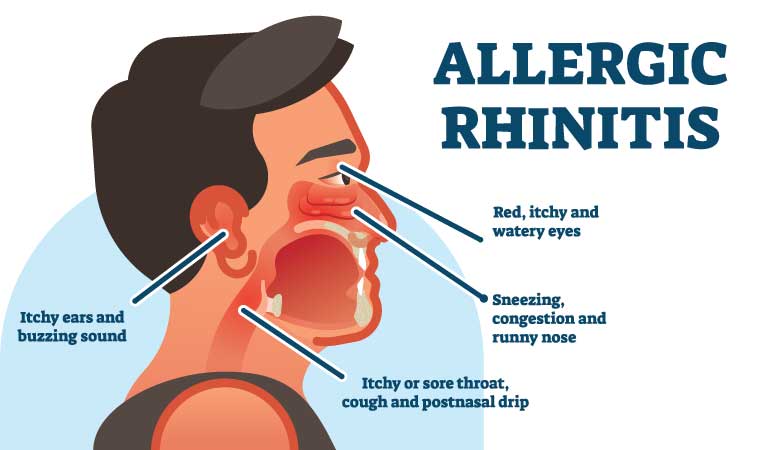 SELF-CARE TIPS TO MANAGE RHINITIS SYMPTOMS | Dr Batra’s™