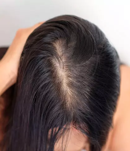 Homeopathy: Best Female Pattern Baldness Treatment