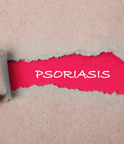 Signs to know if you've psoriasis