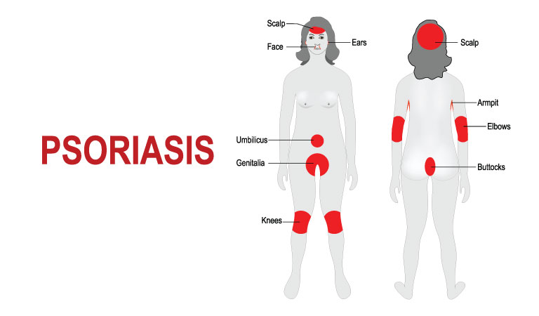 5 Things To Know About Psoriasis Dr Batras™