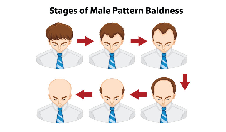 Preventive Tips for Male Pattern Hair Loss