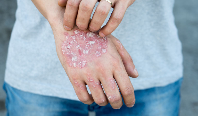 Eczema: Diagnosis & Treatments