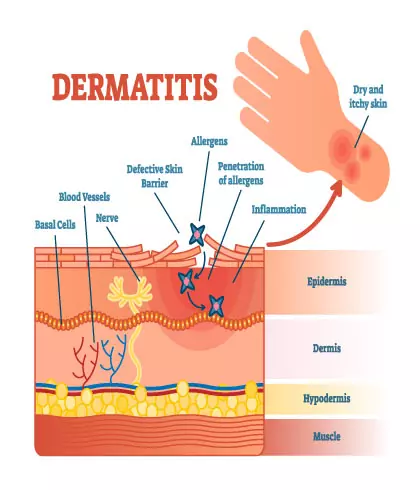 10 things you should know about eczema - Dr Batra’s®