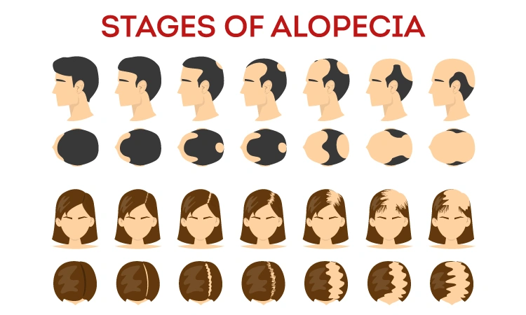 Treat Alopecia Areata with homeopathy