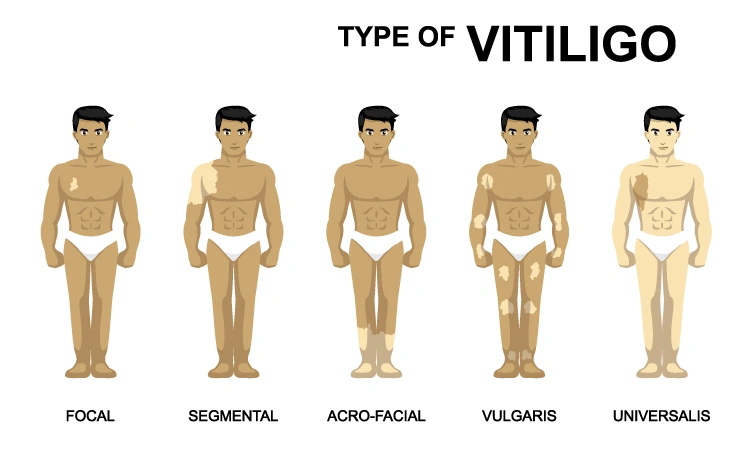 Is vitiligo treatment necessary?