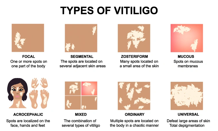 Why summer can be difficult for vitiligo patients