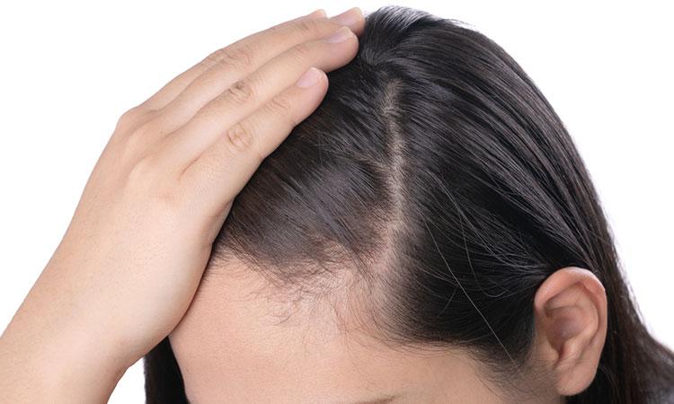 Hair loss: Women speak of pain of going bald - Entertainment - The Jakarta  Post