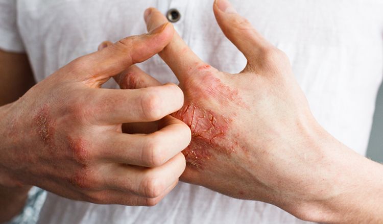 Skin disorders annoying you? Try homeopathy