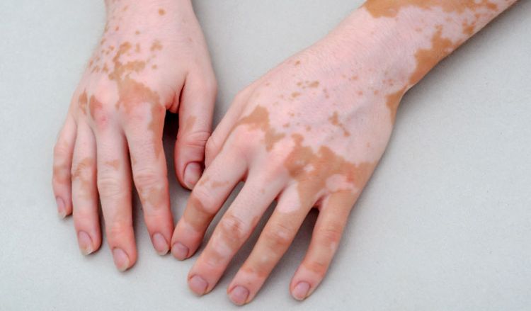 Homeopathy: Best treatment for Vitiligo