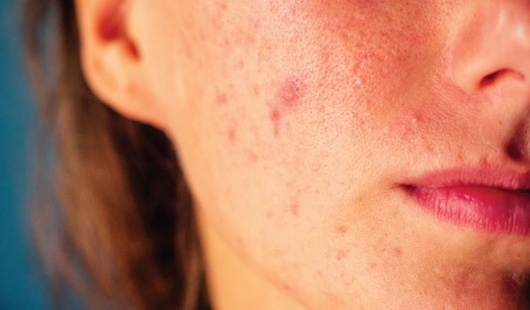 What causes acne?